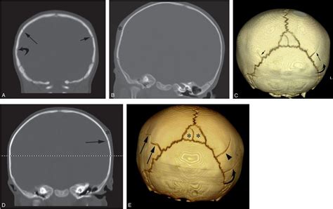 Abusive Head Trauma Scalp Subscalp And Cranium Fe