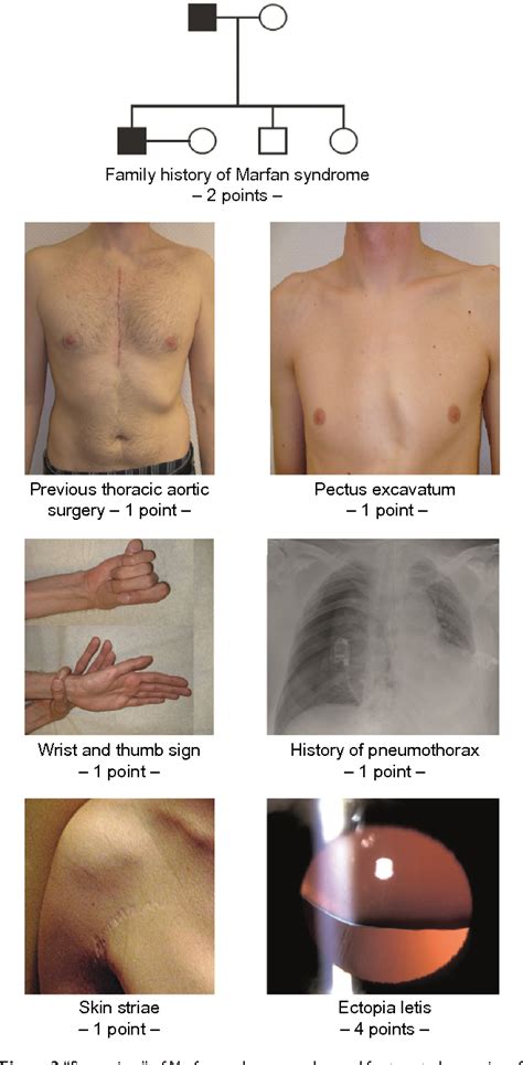 Marfan Syndrome Symptoms