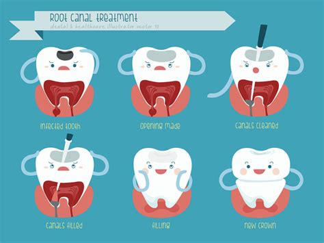 Azle Dentist Deciding Between A Root Canal And Removing Your Tooth