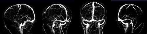 Phase Contrast Mri Phase Contrast Angiography Pca Venc Mri Physics