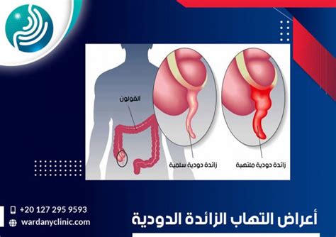 الزائدة الدودية كيفية حدوثها واعراضها وطرق علاجها د إبراهيم الورداني