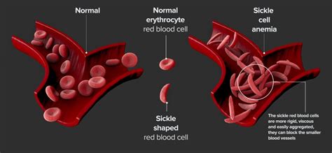 Sickle Cell Disease Scdhec