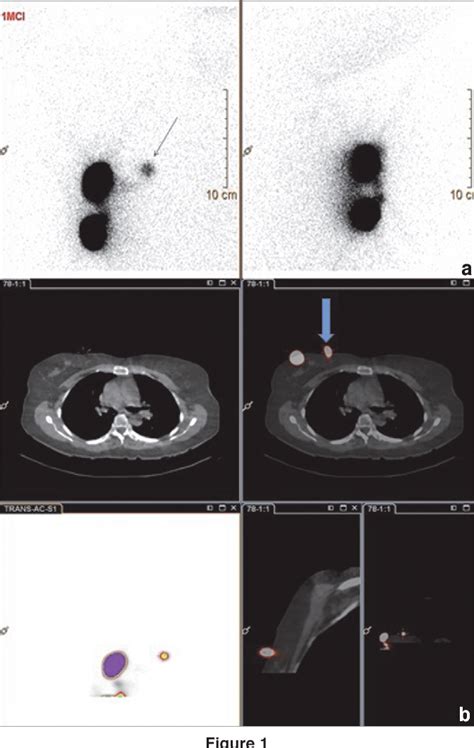 Figure From The Role Of Spect Ct In Detection And Localization Of