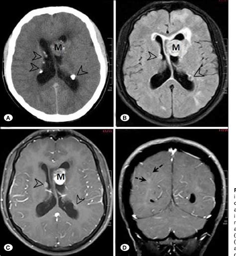 Figure 1 From Leptomeningeal Dissemination Of Intraventricular Rhabdoid