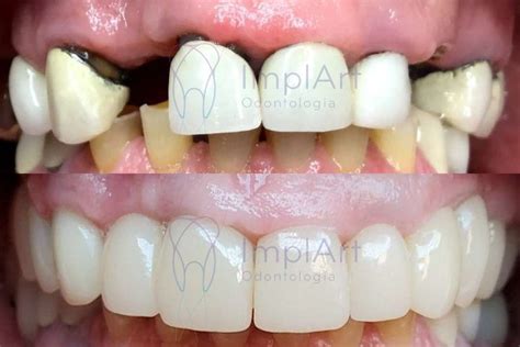 Implantes Coroa Metal Free Antes E Depois Kb Implart