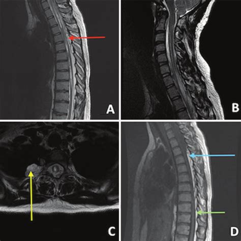 A Sagittal T2 Weighted Mr Image Of The Cervicothoracic Spine