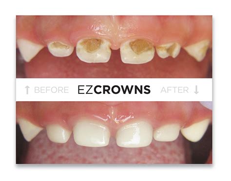 Zirconia Crown Services Bellbrook Pediatric Dentistry