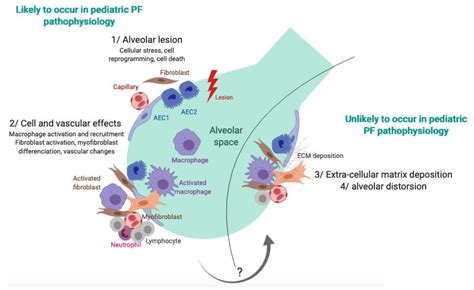 Jcm Free Full Text Pulmonary Fibrosis In Children