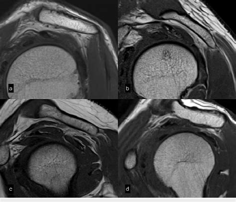 Acromion Types Mri