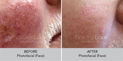 Ipl Photofacial For Rosacea Mac Gate Parkway