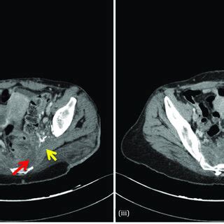 Magnetic Resonance Imaging Of The Pelvis With Contrast Performed For