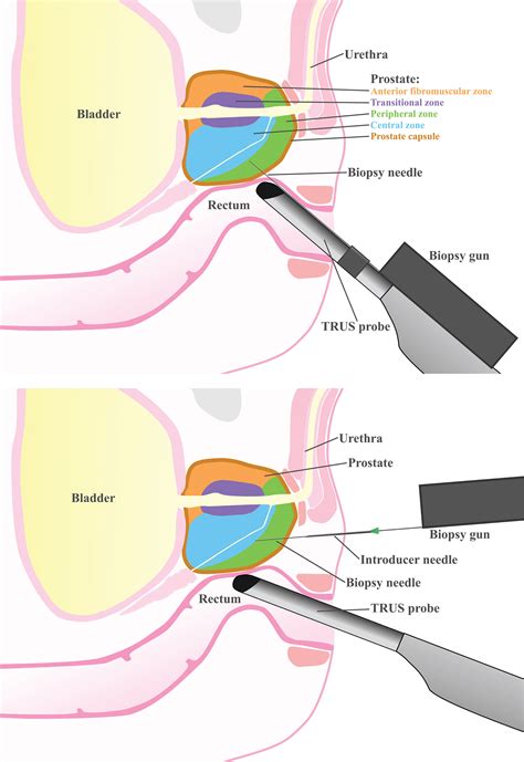 Filediagram Showing A Transperineal Prostate Biopsy Cruk 55 Off