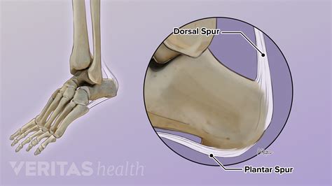 The 2 Common Types Of Heel Spurs Insertional Achilles Tendonitis