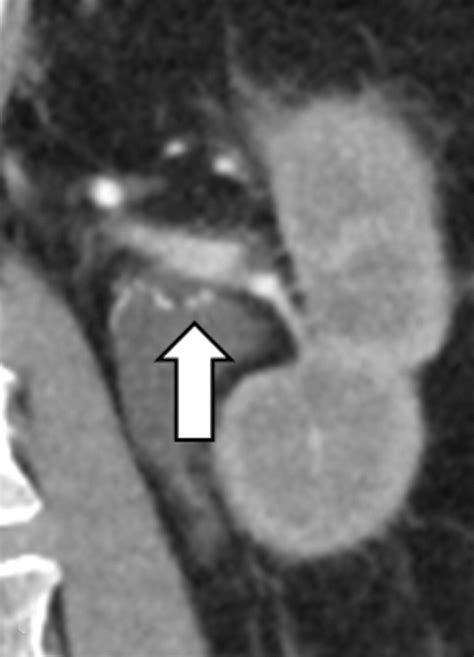 The Renal Vasculature What The Radiologist Needs To Know Radiographics