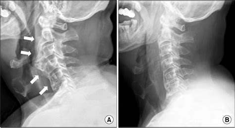 Cervical Osteophytes