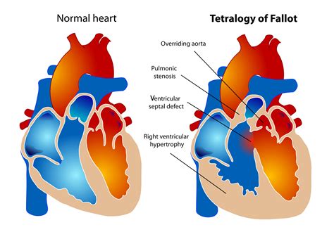 Estenosis Pulmonar Concise Medical Knowledge