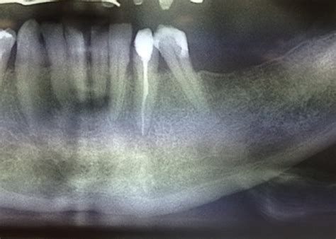 Granuloma treatment - Studio Stradiot