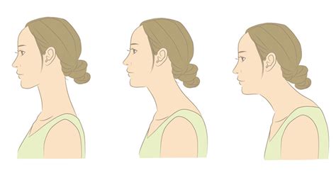 Loss of Cervical Lordosis and Its Connection to Headaches