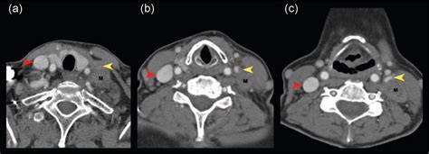 Sonography Of Isolated Internal Jugular Vein Impingement And Thrombosis