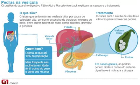 O Que Causa Pedra Na Vesícula - Por Um Triz: Pedra na vesícula (cálculo biliar)