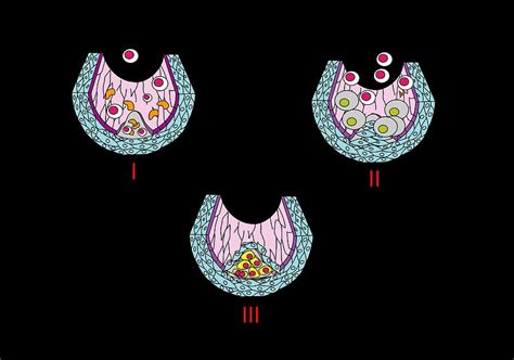 Atheroma Formation Artwork Photograph By Francis Leroy Biocosmos