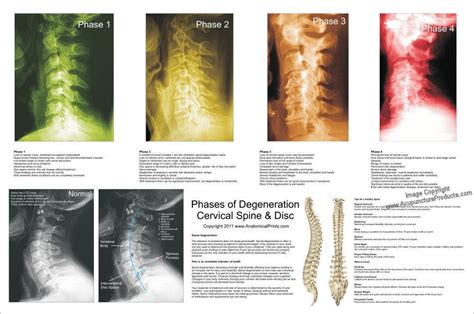 Phases Spinal Degeneration Cervical Spine Poster 24 X 36 Chiropractic Chart