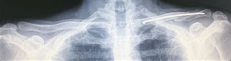 Radiography with anteroposterior incidence and ZANCA, including... | Download Scientific Diagram