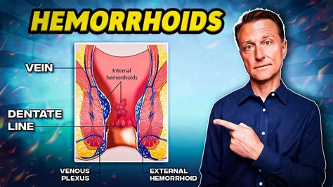 The 1 Best Remedy For Hemorrhoids Dr Berg Youtube