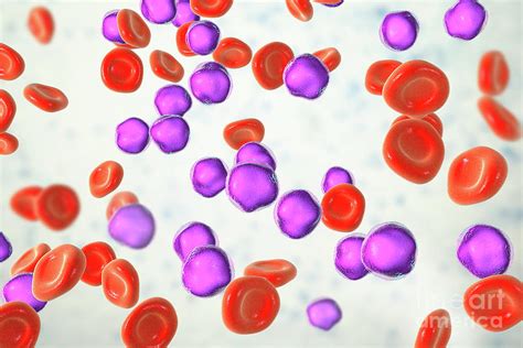 Acute Lymphoblastic Leukaemia Smear Photograph By Kateryna Kon Science