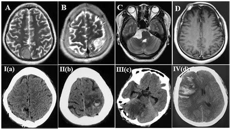 Frontiers Hemorrhagic Cerebral Venous Infarction After Vein Injury