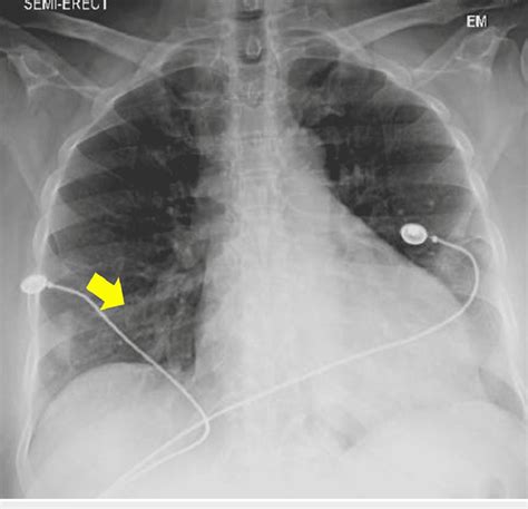 Chest X Ray Showing Nodular Densities In The Right Lower Lung Field Download Scientific Diagram