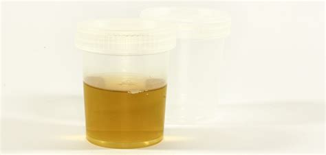 Dark Urine: What Could Be Wrong With You If Your Pee Is Brown Or Black ...