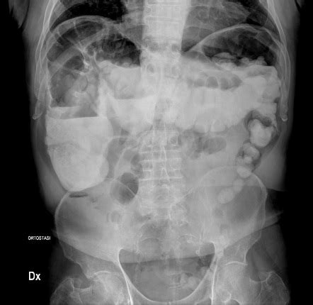 Cecal Bascule Image Radiopaedia Org