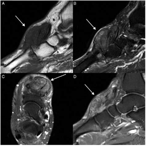 Sagittal T1 Weighted A T2 Weighted B Axial T2 Weighted C And Download Scientific