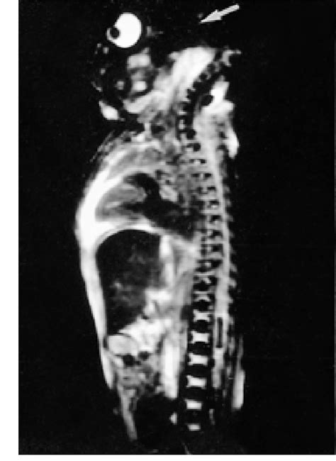 Figure 1 From Can Postmortem Fetal MR Imaging Replace Autopsy