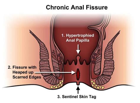 Anal Fissure Causes Symptoms Diagnosis And Treatment Dr Abhijit Gotkhinde