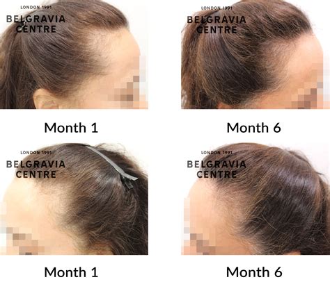 Hair Loss Success Story After 6 Months My Hair Feels Thicker My