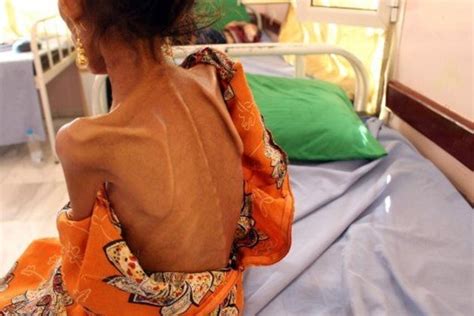 More Than 113 Milion People Suffer Acute Hunger Un