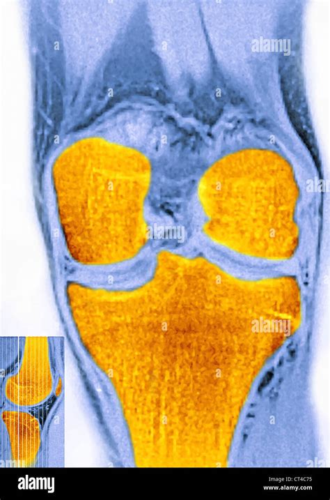 Mri kniegelenk Fotos und Bildmaterial in hoher Auflösung Alamy