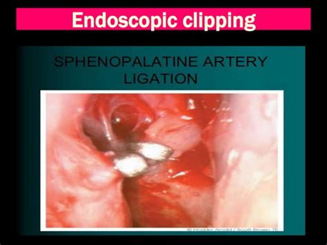 Epistaxis Ppt