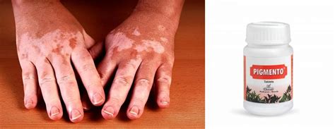 5 Natural Ways to Successfully Deal with Vitiligo - Charak