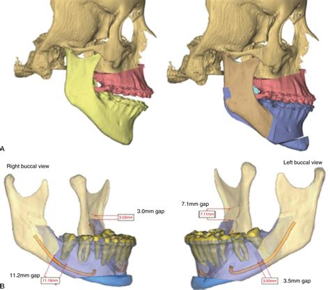 Orthognathic Surgery and Genioplasty - Clinical Tree
