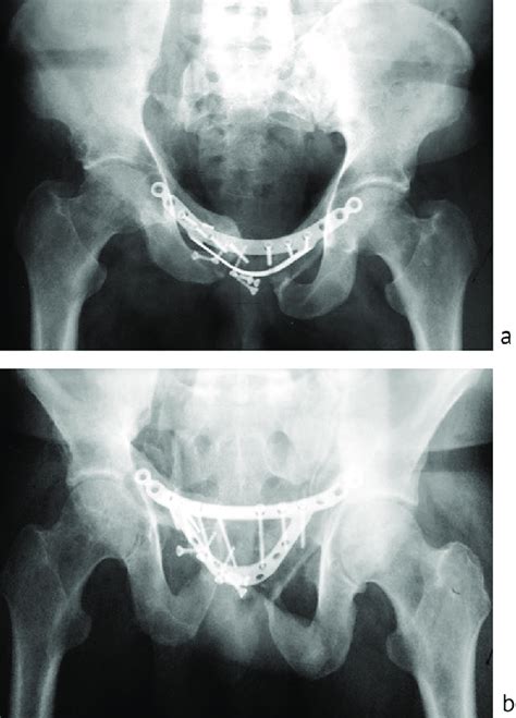 Radiographs Of The Pelvis Of Group Patient At Admission Ap View B