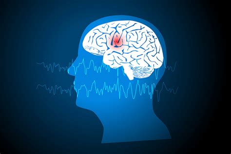 Epilepsia Quais Os Sintomas E Cuidados Necessários