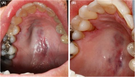 Hemangioma Of The Hard Palate With Invasive Growth Into The Maxillary