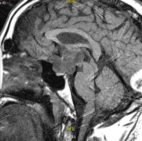 Two Stage Surgical Resection Of A Retrochiasmatic Craniopharyngioma A