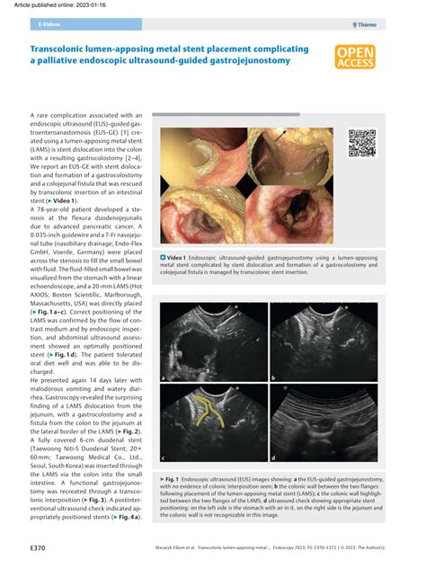 Pdf Transcolonic Lumen Apposing Metal Stent Placement Complicating A