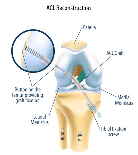 The ACL Injury Guide - A guide for patients about ACL injuries and ACL surgery