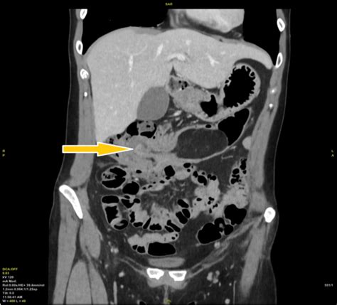 Colo Colic Intussusception At The Level Of Right Hepatic Angle Shown On Download Scientific