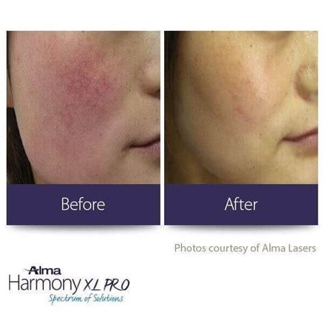 Alma Harmony XL PRO Aesthetics Of Central Texas By Dr Teresa Irwin MD